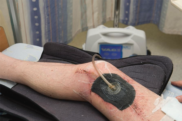 وکیوم تراپی زخم چیست و چه کاربردی دارد؟